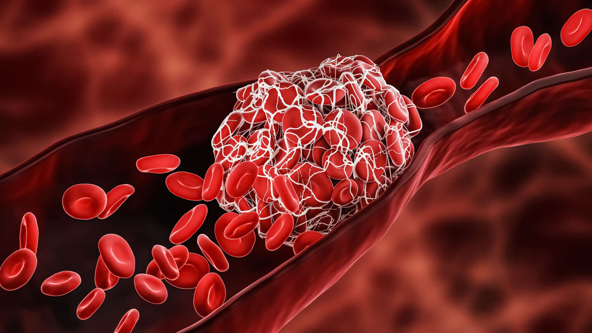 Biologiste365 - Bon Usage Des D-Dimères Lors D'un Diagnostic De MTE