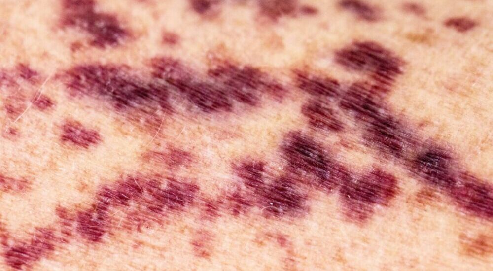photo de purpura sur peau humaine