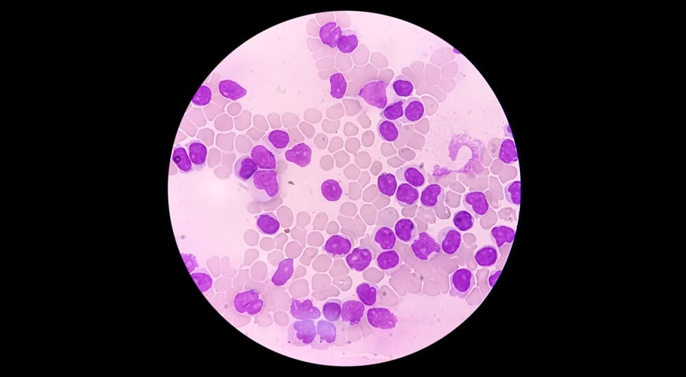 vue microscope d'un frottis sanguin montrant une lymphocytose